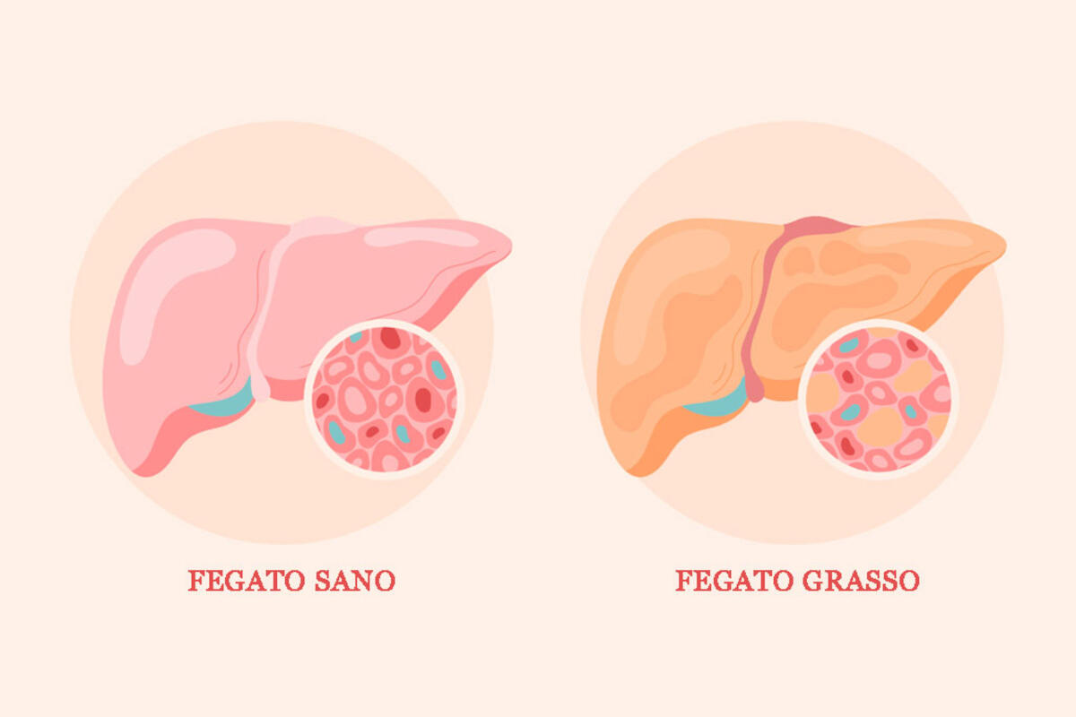 bortoluzzi-fegato-grasso-steatosi